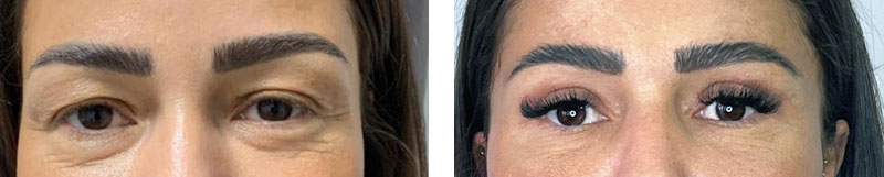 Augenlidstraffung vorher nachher Augenlidstraffung Vorher-Nachher Fotos