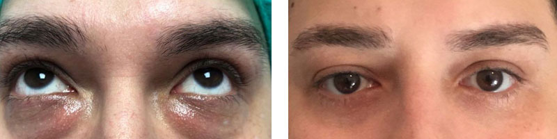 Tränensäcke entfernen Vorher-Nachher Bilder