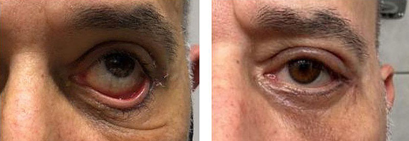 Unterlidstraffung vorher nachher